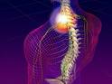 Treating Chronic Neck Pain Video